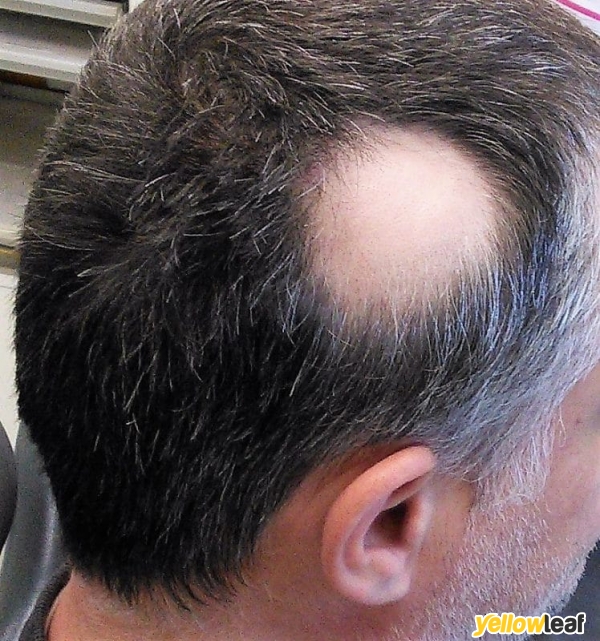 Scalp Micro Pigmentation by Skulltec